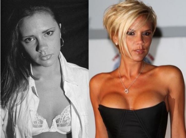 VICTORIA-BECKHAM-chirurgia-plastica