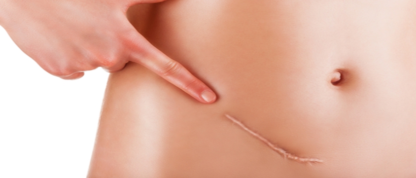 Cicatrici-cesareo