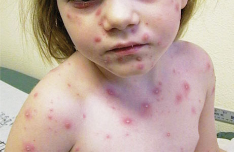 malattie_esantematiche